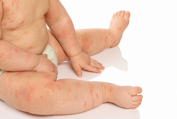 Inflamed atopic skin in a child