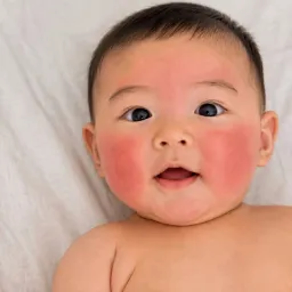 Child with signs of atopic dermatitis on the arm